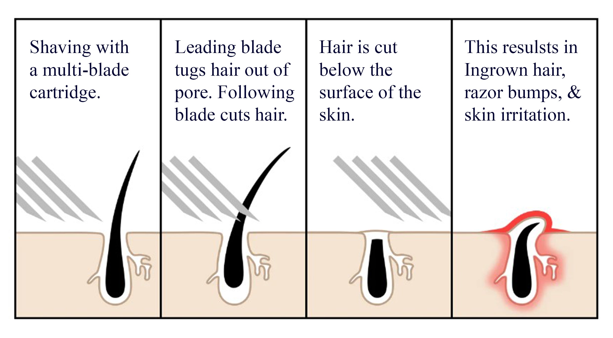 How Cartridge Razors Contribute to Ingrown Hairs – Kronos