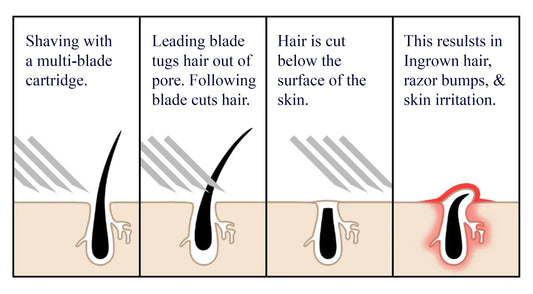 How Cartridge Razors Contribute to Ingrown Hairs